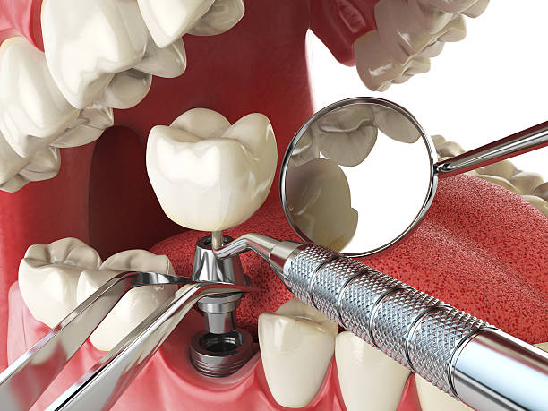 Best Emergency Dentist for Knocked-Out Tooth in Smyrna, TN